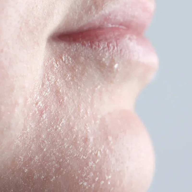 Dry Skin