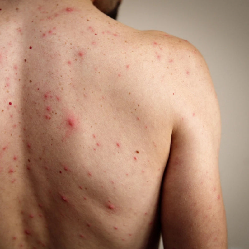 Body Acne