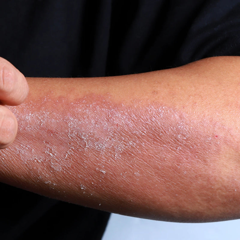 Dry Skin